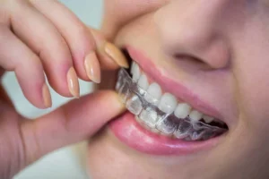 Step-by-Step Invisalign Treatment Journey: What to Expect