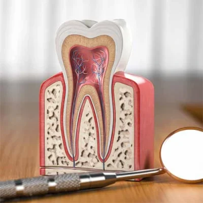 Root Canal Treatment in Tripunithura, Kochi